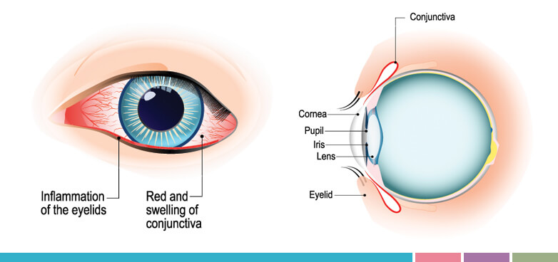 El verano, con el calor y el contacto con sustancias irritantes, puede favorecer la aparición de patologías como la conjuntivitis o la queratitis, los orzuelos o las celulitis palpebrales. 