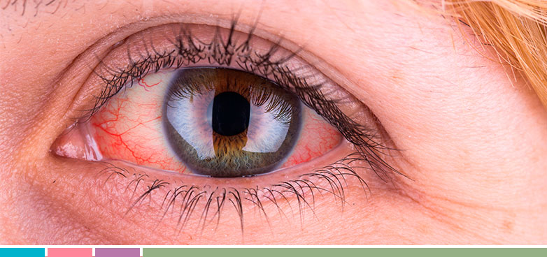 Lentes De Contacto Ojos Rojos Cheap Sale, 60% OFF | www.ingeniovirtual.com