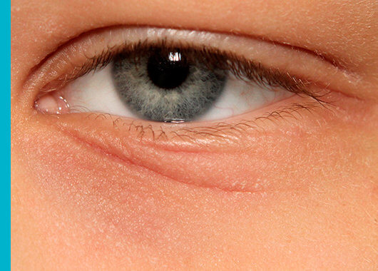 Dermatitis atópica también en los ojos