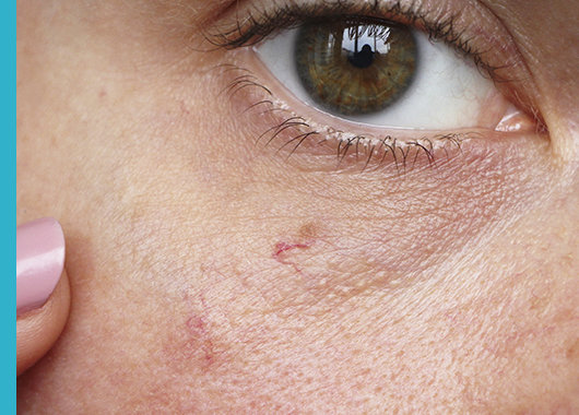 ¿Cómo afecta la piel sensible al ojo sensible?